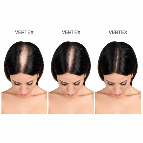 FOLIGAIN® Women's Hair Regrowth Kit - FOLIGAIN EUROPE