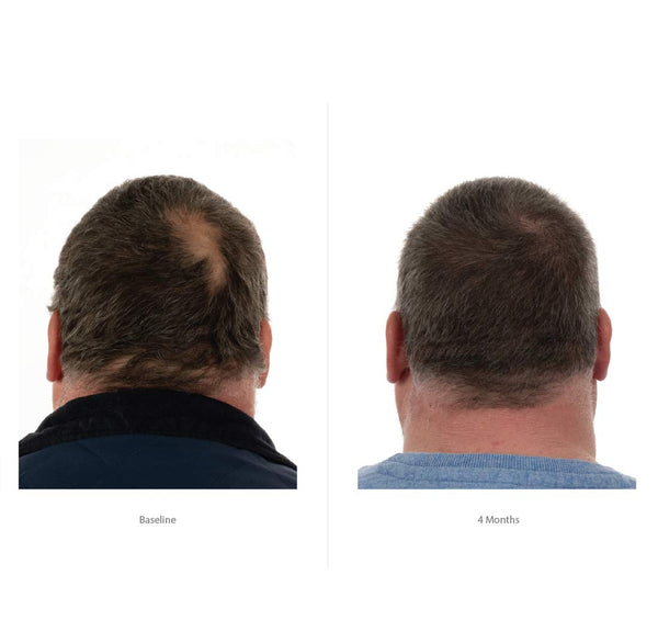 FOLIGAIN® Advanced Hair Regrowth For Men Minoxidil 5% + TRIOXIDIL®   5% - FOLIGAIN EUROPE