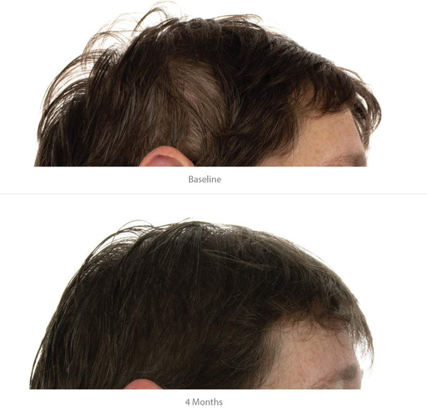 FOLIGAIN Triple Action Shampoo For Thinning Hair For Women with 2% Trioxidil - FOLIGAIN EUROPE